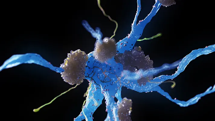 Nerve cells affected by Alzheimer's disease Nerve cells affected by Alzheimer's disease